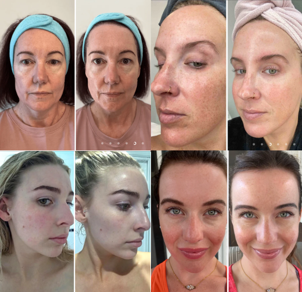 CollagenLift+ – Máscara Absorvível com Colágeno + Peptídeos Rejuvenescedores